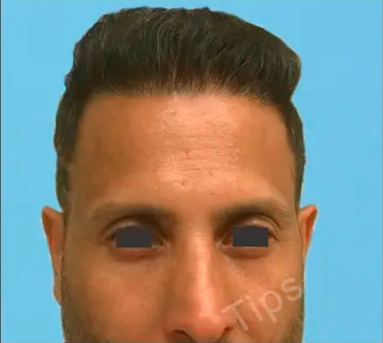 Before hair transplant surgery result at TIPS
