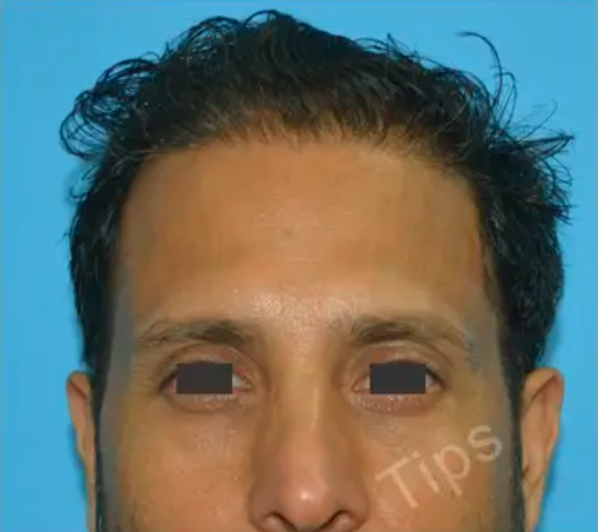 After hair transplant surgery result at TIPS