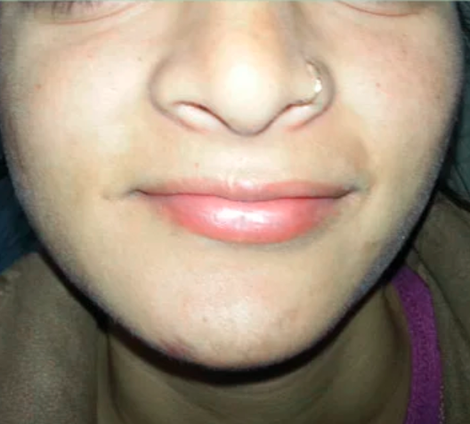 Before scare surgery result at TIPS