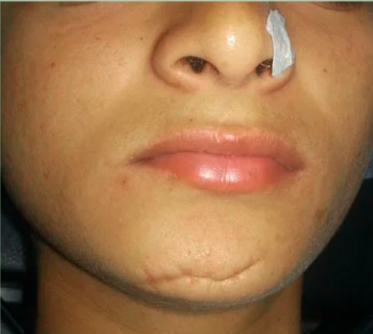 After scare surgery result at TIPS