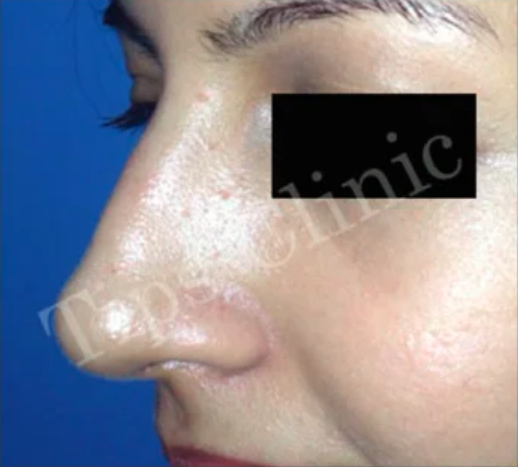 Before nose surgery result at TIPS