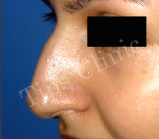 After nose surgery result at TIPS