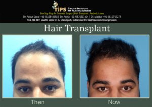 Hair Transplant before and after images | Best Hair Transplant in Chandigarh, India
