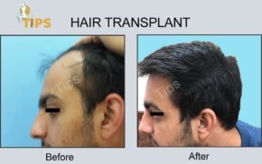 Hair Transplant FAQ in Chandigarh, India