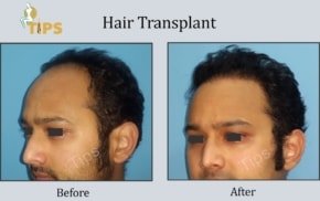 Hair Transplant FAQ in Punjab, India