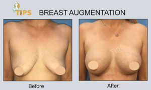 Breast Implant before & after surgery done at TIPS