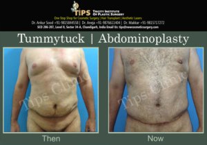 tummy tuck-abdominoplasty before and after images | Tummy tuck surgery in Chandigarh, India