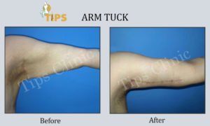 Arm Lift before and after image | Arm lift in Chandigarh, India