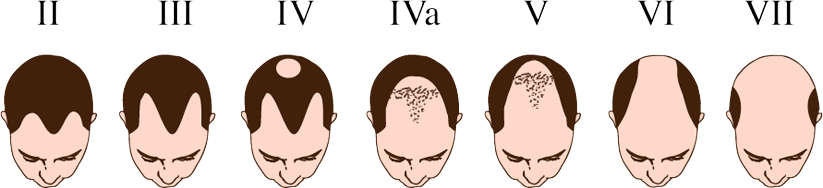 Stages of Baldness in people | Hair fall in men & women