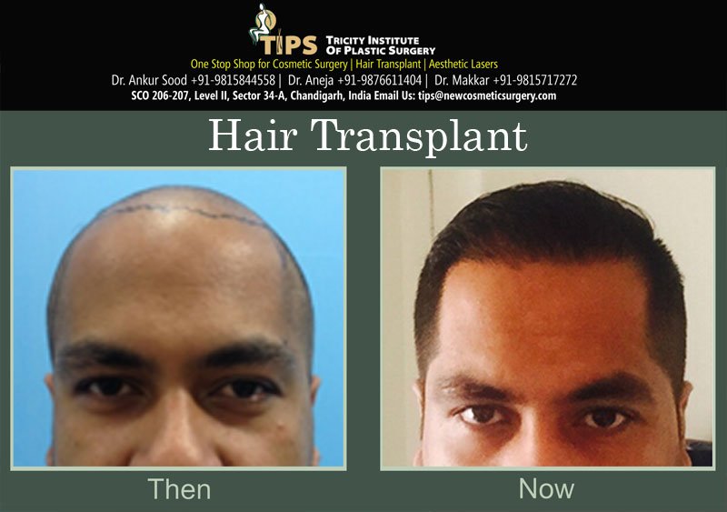 Hair Transplant before & after images | Hair loss treatment before & after pictures